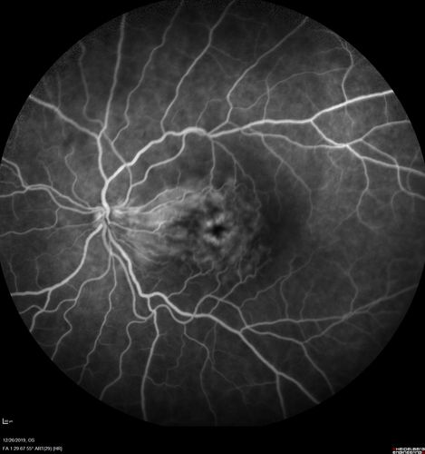 Cystoid Macular Edema and Macular Pucker
has been particular bad for 3 years.  She has a macular pucker and severe CME.

VA 20/160 left eye
