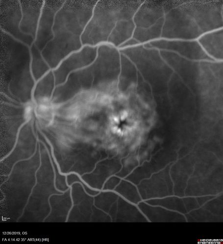 Cystoid Macular Edema and Macular Pucker
has been particular bad for 3 years.  She has a macular pucker and severe CME.

VA 20/160 left eye
