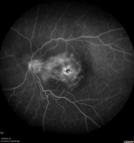 Cystoid Macular Edema and Macular Pucker
has been particular bad for 3 years.  She has a macular pucker and severe CME.

VA 20/160 left eye
