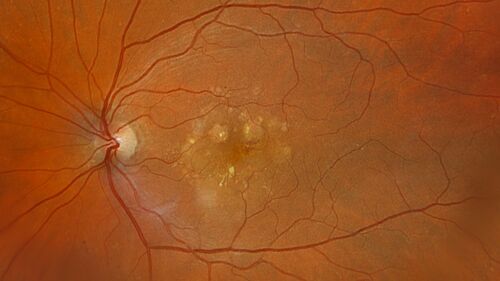 Wet AMD - Occult CNVM and Geographic atrophy
77 year old female with mild vision loss - 20/32 - responded to Avastin
