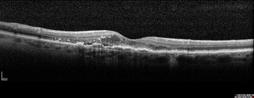 Wet AMD - Occult CNVM and Geographic atrophy
77 year old female with mild vision loss - 20/32 - responded to Avastin
