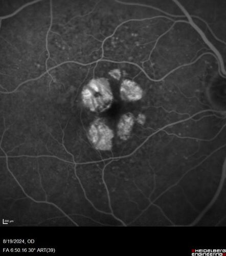 Wet AMD - Occult CNVM and Geographic atrophy
77 year old female with mild vision loss - 20/32 - responded to Avastin
