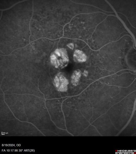 Wet AMD - Occult CNVM and Geographic atrophy
77 year old female with mild vision loss - 20/32 - responded to Avastin
