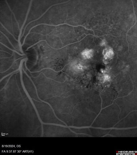 Wet AMD - Occult CNVM and Geographic atrophy
77 year old female with mild vision loss - 20/32 - responded to Avastin
