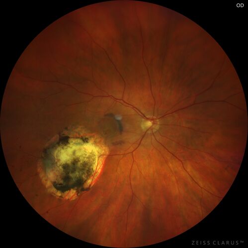 Choroidal Neovascular Membrane (CNVM) secondary to laser scar from TTT for choroidal melanoma 20 years earlier
71-year old female - Vision loss in the right eye for 1 week.  She had transpupillary thermotherapy 20 years ago in the right eye for choroidal melanoma.
VA 4/200 OD, 20/20 OS
