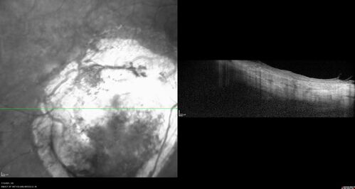 Choroidal Neovascular Membrane (CNVM) secondary to laser scar from TTT for choroidal melanoma 20 years earlier
71-year old female - Vision loss in the right eye for 1 week.  She had transpupillary thermotherapy 20 years ago in the right eye for choroidal melanoma.
VA 4/200 OD, 20/20 OS

