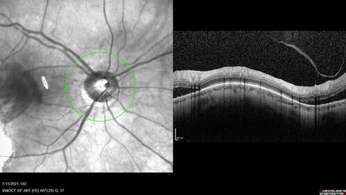 Choroidal Neovascular Membrane (CNVM) secondary to laser scar from TTT for choroidal melanoma 20 years earlier
71-year old female - Vision loss in the right eye for 1 week.  She had transpupillary thermotherapy 20 years ago in the right eye for choroidal melanoma.
VA 4/200 OD, 20/20 OS
