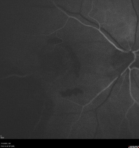 Choroidal Neovascular Membrane (CNVM) secondary to laser scar from TTT for choroidal melanoma 20 years earlier
71-year old female - Vision loss in the right eye for 1 week.  She had transpupillary thermotherapy 20 years ago in the right eye for choroidal melanoma.
VA 4/200 OD, 20/20 OS
