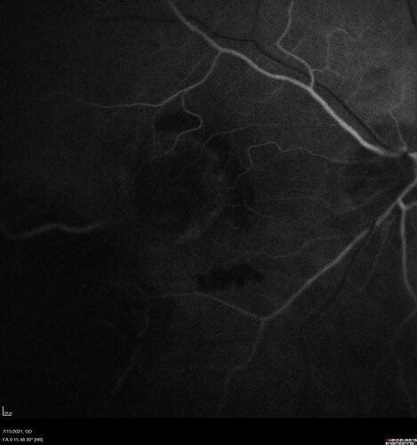 Choroidal Neovascular Membrane (CNVM) secondary to laser scar from TTT for choroidal melanoma 20 years earlier
71-year old female - Vision loss in the right eye for 1 week.  She had transpupillary thermotherapy 20 years ago in the right eye for choroidal melanoma.
VA 4/200 OD, 20/20 OS
