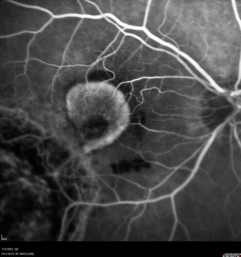 Choroidal Neovascular Membrane (CNVM) secondary to laser scar from TTT for choroidal melanoma 20 years earlier
71-year old female - Vision loss in the right eye for 1 week.  She had transpupillary thermotherapy 20 years ago in the right eye for choroidal melanoma.
VA 4/200 OD, 20/20 OS
