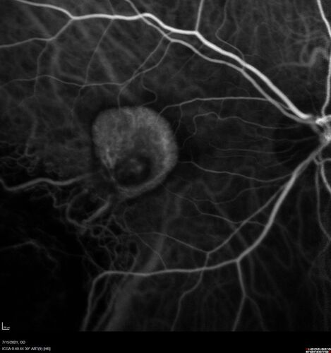 Choroidal Neovascular Membrane (CNVM) secondary to laser scar from TTT for choroidal melanoma 20 years earlier
71-year old female - Vision loss in the right eye for 1 week.  She had transpupillary thermotherapy 20 years ago in the right eye for choroidal melanoma.
VA 4/200 OD, 20/20 OS
