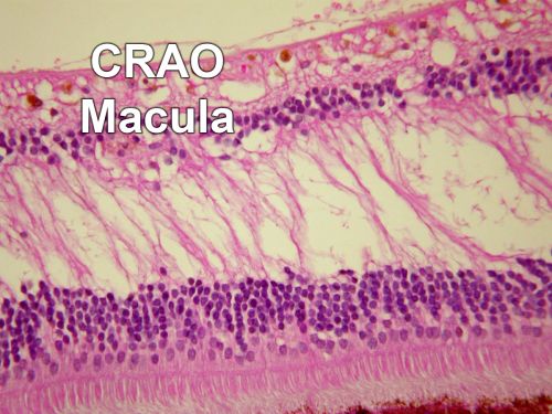 Pathology - Central Retinal Artery Occlusion - 6 weeks old - Inner Retinal Atrophy
patient died about 6 to 8 weeks after the artery occlusion, and he had no history of glaucoma. The inner retina atrophy, which looks very similar to that caused by COAG, is due to recent infarct. 

