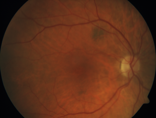 Acute Central Retinal Artery Occlusion
1 day of vision loss 79 year old man to HM.  NVG developed 2 months later.
