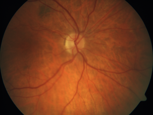 Acute Central Retinal Artery Occlusion
1 day of vision loss 79 year old man to HM.  NVG developed 2 months later.
