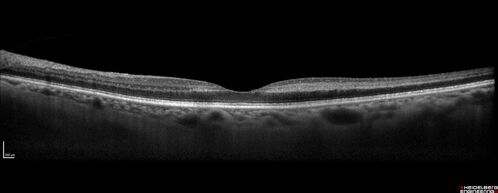 Central retinal artery occlusion and paracentral acute middle maculopathy and emboli
86 year old female with sudden vision loss a week ago and imaging shows PAMM lesions and emboli.  Her vision is 20/200 in the left eye
