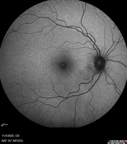 Central retinal artery occlusion and paracentral acute middle maculopathy and emboli
86 year old female with sudden vision loss a week ago and imaging shows PAMM lesions and emboli.  Her vision is 20/200 in the left eye
