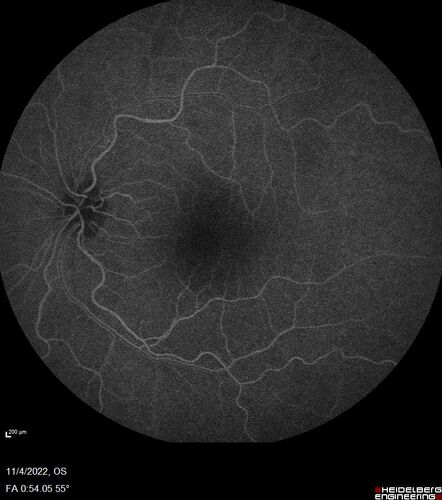 Central retinal artery occlusion and paracentral acute middle maculopathy and emboli
86 year old female with sudden vision loss a week ago and imaging shows PAMM lesions and emboli.  Her vision is 20/200 in the left eye
