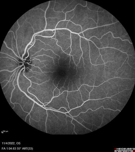 Central retinal artery occlusion and paracentral acute middle maculopathy and emboli
86 year old female with sudden vision loss a week ago and imaging shows PAMM lesions and emboli.  Her vision is 20/200 in the left eye
