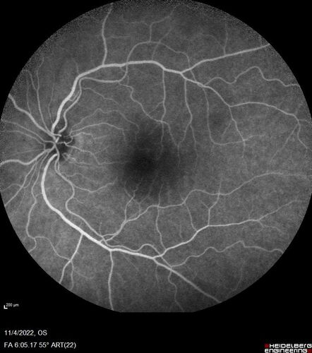 Central retinal artery occlusion and paracentral acute middle maculopathy and emboli
86 year old female with sudden vision loss a week ago and imaging shows PAMM lesions and emboli.  Her vision is 20/200 in the left eye

