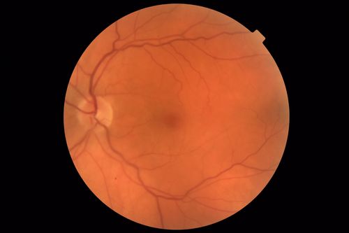 Central Retinal Artery Occlusion - Diabetic Retinopathy - NO cherry red spot
58 year old man with sudden vision loss in the right eye.  The vision had been 20/40 and dropped to 20/200 the day prior to presentation.  
VA 20/200 OD, 20/20 OS
FA shows CRAO.  No cherry red spot.

