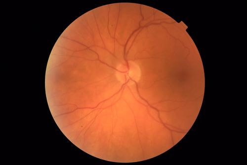 Central Retinal Artery Occlusion - Diabetic Retinopathy - NO cherry red spot
58 year old man with sudden vision loss in the right eye.  The vision had been 20/40 and dropped to 20/200 the day prior to presentation.  
VA 20/200 OD, 20/20 OS
FA shows CRAO.  No cherry red spot.
