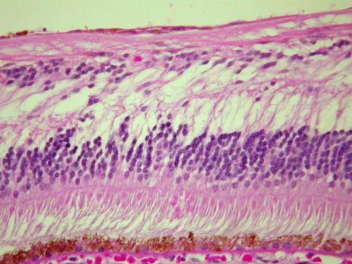 Pathology - Central Retinal Artery Occlusion - 6 weeks old - Inner Retinal Atrophy - Macular Pucker
patient died about 6 to 8 weeks after the artery occlusion, and he had no history of glaucoma. The inner retina atrophy, which looks very similar to that caused by COAG, is due to recent infarct. 
