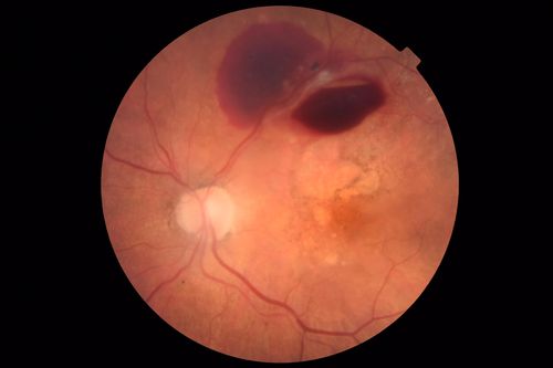 Ischemic CRVO OD and Arterial Macroaneurysm OS
83 year old female post PPV, Laser, Ahmed valve for CRVO with vitreous heme and NVG in the right eye.  VA was 20/160 3 months following vitrectomy.  Left eye has MA which was not treated and involuted post-heme

