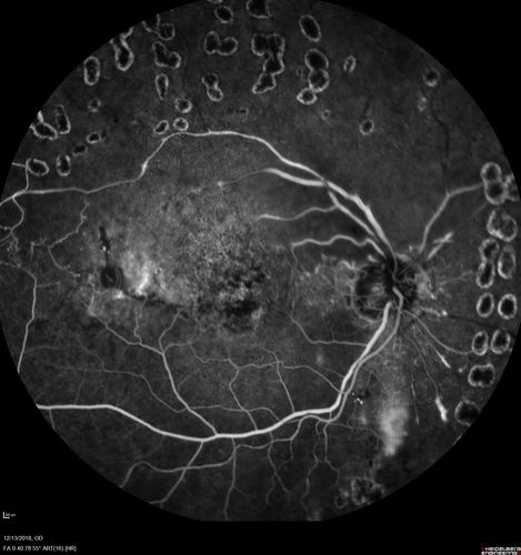 Ischemic CRVO OD and Arterial Macroaneurysm OS
83 year old female post PPV, Laser, Ahmed valve for CRVO with vitreous heme and NVG in the right eye.  VA was 20/160 3 months following vitrectomy.  Left eye has MA which was not treated and involuted post-heme
