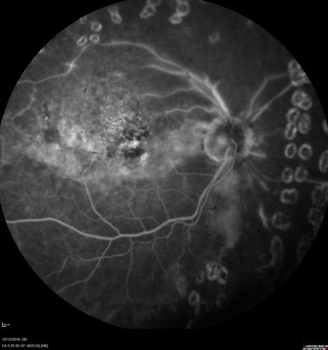 Ischemic CRVO OD and Arterial Macroaneurysm OS
83 year old female post PPV, Laser, Ahmed valve for CRVO with vitreous heme and NVG in the right eye.  VA was 20/160 3 months following vitrectomy.  Left eye has MA which was not treated and involuted post-heme
