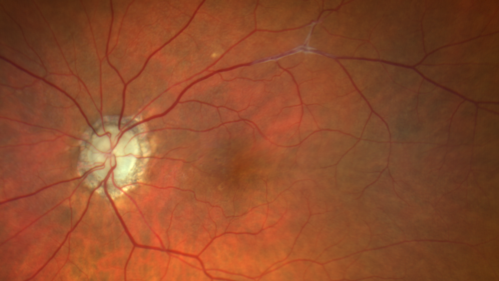 CRVO Shunt Vessels Right Eye - Optociliary Shunt Vessels
Prior CRVO right eye treated with injections
