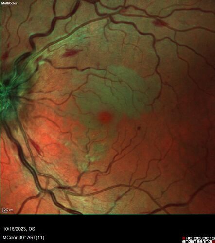 Central Retinal Vein Occlusion with cilioretinal artery occlusion
63 year old female who lost vision in the left eye 2 days ago. She was in the emergency room and had a lot of tests done which were all reportedly normal. The right eye is OK.
VA OD: Dcc20/25 NccJ2
VA OS: Dcc20/200-1 PHNI Ncc20/400-1
IOP: TP: OD:11 OS:12
