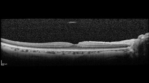 Central Retinal Vein Occlusion with cilioretinal artery occlusion
63 year old female who lost vision in the left eye 2 days ago. She was in the emergency room and had a lot of tests done which were all reportedly normal. The right eye is OK.
VA OD: Dcc20/25 NccJ2
VA OS: Dcc20/200-1 PHNI Ncc20/400-1
IOP: TP: OD:11 OS:12
