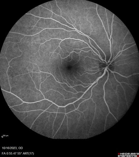 Central Retinal Vein Occlusion with cilioretinal artery occlusion
63 year old female who lost vision in the left eye 2 days ago. She was in the emergency room and had a lot of tests done which were all reportedly normal. The right eye is OK.
VA OD: Dcc20/25 NccJ2
VA OS: Dcc20/200-1 PHNI Ncc20/400-1
IOP: TP: OD:11 OS:12

