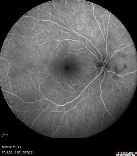 Central Retinal Vein Occlusion with cilioretinal artery occlusion
63 year old female who lost vision in the left eye 2 days ago. She was in the emergency room and had a lot of tests done which were all reportedly normal. The right eye is OK.
VA OD: Dcc20/25 NccJ2
VA OS: Dcc20/200-1 PHNI Ncc20/400-1
IOP: TP: OD:11 OS:12
