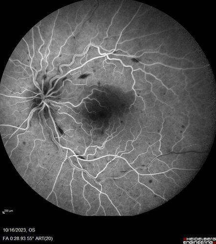 Central Retinal Vein Occlusion with cilioretinal artery occlusion
63 year old female who lost vision in the left eye 2 days ago. She was in the emergency room and had a lot of tests done which were all reportedly normal. The right eye is OK.
VA OD: Dcc20/25 NccJ2
VA OS: Dcc20/200-1 PHNI Ncc20/400-1
IOP: TP: OD:11 OS:12

