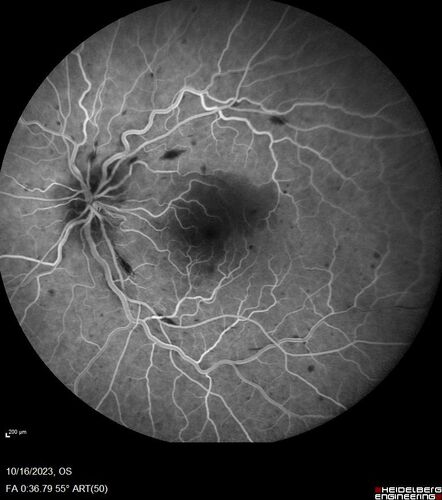 Central Retinal Vein Occlusion with cilioretinal artery occlusion
63 year old female who lost vision in the left eye 2 days ago. She was in the emergency room and had a lot of tests done which were all reportedly normal. The right eye is OK.
VA OD: Dcc20/25 NccJ2
VA OS: Dcc20/200-1 PHNI Ncc20/400-1
IOP: TP: OD:11 OS:12
