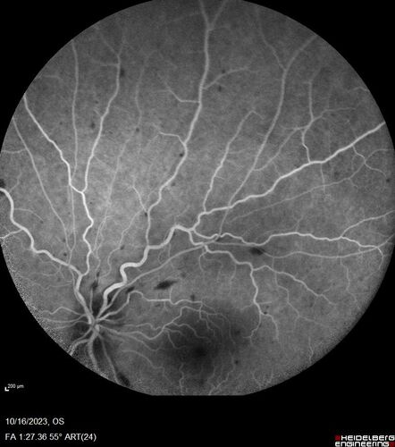 Central Retinal Vein Occlusion with cilioretinal artery occlusion
63 year old female who lost vision in the left eye 2 days ago. She was in the emergency room and had a lot of tests done which were all reportedly normal. The right eye is OK.
VA OD: Dcc20/25 NccJ2
VA OS: Dcc20/200-1 PHNI Ncc20/400-1
IOP: TP: OD:11 OS:12
