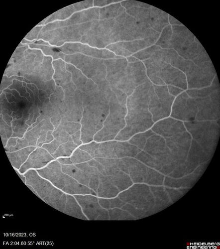 Central Retinal Vein Occlusion with cilioretinal artery occlusion
63 year old female who lost vision in the left eye 2 days ago. She was in the emergency room and had a lot of tests done which were all reportedly normal. The right eye is OK.
VA OD: Dcc20/25 NccJ2
VA OS: Dcc20/200-1 PHNI Ncc20/400-1
IOP: TP: OD:11 OS:12
