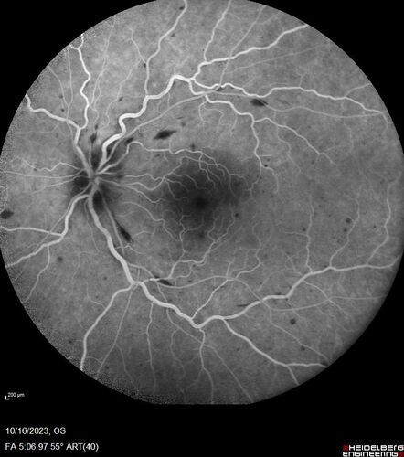 Central Retinal Vein Occlusion with cilioretinal artery occlusion
63 year old female who lost vision in the left eye 2 days ago. She was in the emergency room and had a lot of tests done which were all reportedly normal. The right eye is OK.
VA OD: Dcc20/25 NccJ2
VA OS: Dcc20/200-1 PHNI Ncc20/400-1
IOP: TP: OD:11 OS:12
