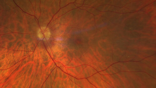Central Retinal Vein Occlusion with cilioretinal artery occlusion
63 year old female who lost vision in the left eye 2 days ago. She was in the emergency room and had a lot of tests done which were all reportedly normal. The right eye is OK.
VA OD: Dcc20/25 NccJ2
VA OS: Dcc20/200-1 PHNI Ncc20/400-1
IOP: TP: OD:11 OS:12
