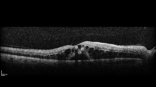 Central Retinal Vein Occlusion - Non-Ischemic - Excellent Outcome
57 year old man The right eye has had vision loss for about 3 weeks.  He woke up with vision loss. 
Medical Hx: HIV . Diabetes Mellitus (since 2014). Thyroid Disease. 
Systemic Meds: gemboya. Metformin Hydrochloride. trulicity. losartan. vesepa. Synthroid .
VA OD: sc20/160 OS: sc20/20 
TP: OD:14 OS:14
Treated with Avastin
VA 6 weeks later 20/32 – dry one shot.
Missed follow-up after second treatment and came  5 months later with good vision and no macular edema
