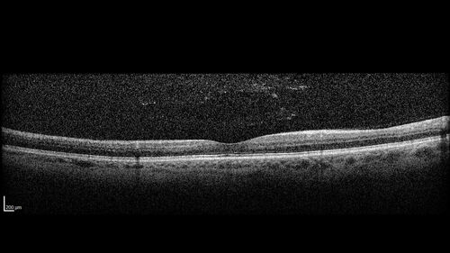 Central Retinal Vein Occlusion - Non-Ischemic - Excellent Outcome
57 year old man The right eye has had vision loss for about 3 weeks.  He woke up with vision loss. 
Medical Hx: HIV . Diabetes Mellitus (since 2014). Thyroid Disease. 
Systemic Meds: gemboya. Metformin Hydrochloride. trulicity. losartan. vesepa. Synthroid .
VA OD: sc20/160 OS: sc20/20 
TP: OD:14 OS:14
Treated with Avastin
VA 6 weeks later 20/32 – dry one shot.
Missed follow-up after second treatment and came  5 months later with good vision and no macular edema
