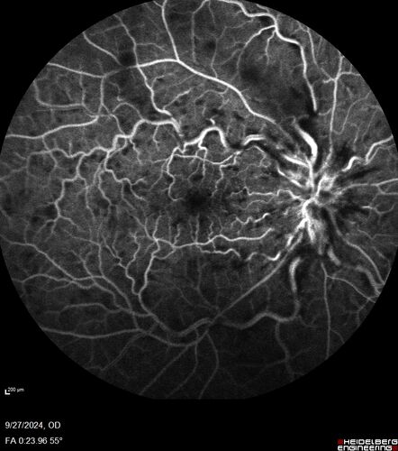 Central Retinal Vein Occlusion - Non-Ischemic - Excellent Outcome
57 year old man The right eye has had vision loss for about 3 weeks.  He woke up with vision loss. 
Medical Hx: HIV . Diabetes Mellitus (since 2014). Thyroid Disease. 
Systemic Meds: gemboya. Metformin Hydrochloride. trulicity. losartan. vesepa. Synthroid .
VA OD: sc20/160 OS: sc20/20 
TP: OD:14 OS:14
Treated with Avastin
VA 6 weeks later 20/32 – dry one shot.
Missed follow-up after second treatment and came  5 months later with good vision and no macular edema
