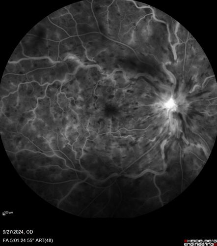Central Retinal Vein Occlusion - Non-Ischemic - Excellent Outcome
57 year old man The right eye has had vision loss for about 3 weeks.  He woke up with vision loss. 
Medical Hx: HIV . Diabetes Mellitus (since 2014). Thyroid Disease. 
Systemic Meds: gemboya. Metformin Hydrochloride. trulicity. losartan. vesepa. Synthroid .
VA OD: sc20/160 OS: sc20/20 
TP: OD:14 OS:14
Treated with Avastin
VA 6 weeks later 20/32 – dry one shot.
Missed follow-up after second treatment and came  5 months later with good vision and no macular edema
