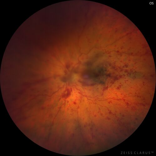 central retinal vein occlusion - a lot of hemorrhage - on coumadin
84 year old man with severe vision loss left eye for 2 weeks.  VA 5/200 OS - Patient on Warfarin for valve replacement.
