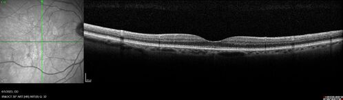 central retinal vein occlusion - a lot of hemorrhage - on coumadin
84 year old man with severe vision loss left eye for 2 weeks.  VA 5/200 OS - Patient on Warfarin for valve replacement.

