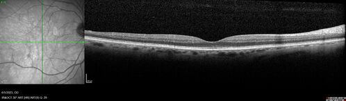 central retinal vein occlusion - a lot of hemorrhage - on coumadin
84 year old man with severe vision loss left eye for 2 weeks.  VA 5/200 OS - Patient on Warfarin for valve replacement.
