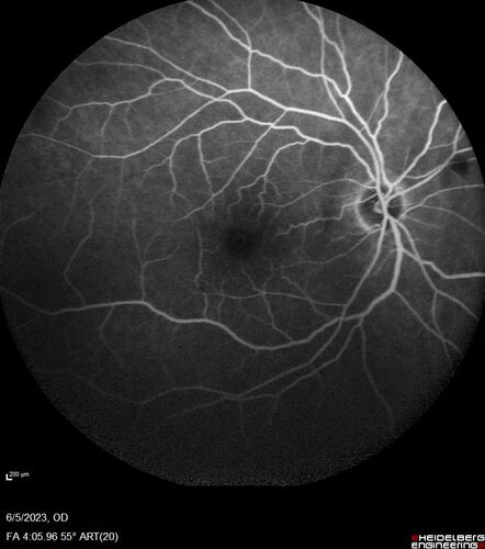 central retinal vein occlusion - a lot of hemorrhage - on coumadin
84 year old man with severe vision loss left eye for 2 weeks.  VA 5/200 OS - Patient on Warfarin for valve replacement.
