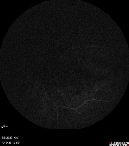 central retinal vein occlusion - a lot of hemorrhage - on coumadin
84 year old man with severe vision loss left eye for 2 weeks.  VA 5/200 OS - Patient on Warfarin for valve replacement.
