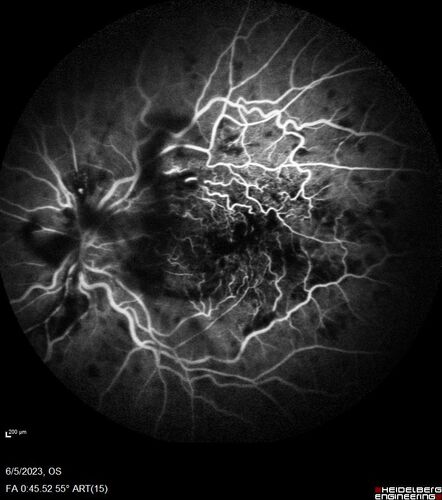 central retinal vein occlusion - a lot of hemorrhage - on coumadin
84 year old man with severe vision loss left eye for 2 weeks.  VA 5/200 OS - Patient on Warfarin for valve replacement.
